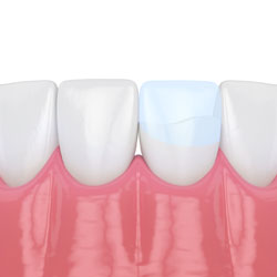 tooth repair bonding