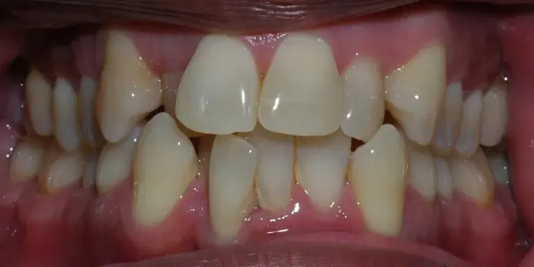 Before Invisalign with visible crooked top and bottom row teeth