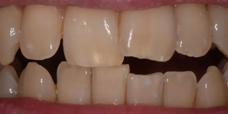 Before dental bonding procedure with misshapen front left tooth