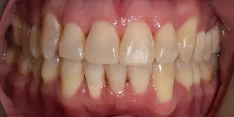 After Invisalign with visible crooked top and bottom row teeth