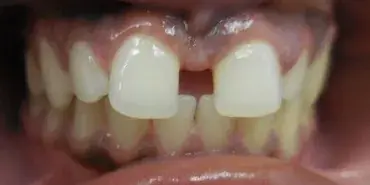 Before Invisalign with large front tooth gap