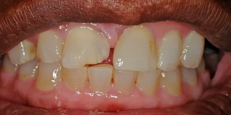Before of dental bonding with misshapen front right tooth
