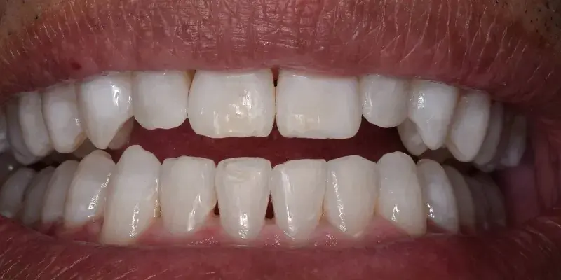 After of full dental work with KöR whitening, Invisalign, dental bonding