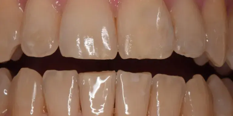 After dental bonding procedure with misshapen front left tooth