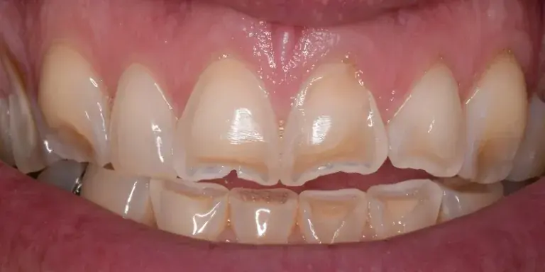 Before of porcelain veneers with visible teeth staining