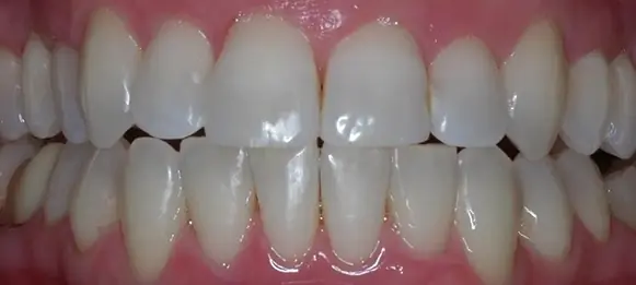 After Invisalign with right side crooked teeth
