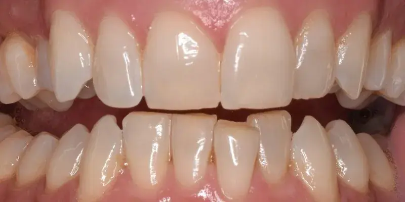 Before Invisalign with bottom row tooth correction
