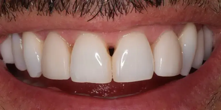 Before of dental bonding with visible gap in front teeth
