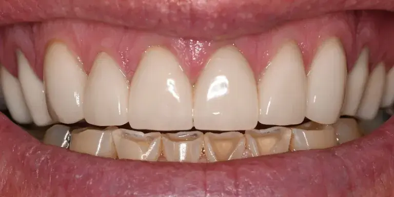 After of porcelain veneers with visible teeth staining