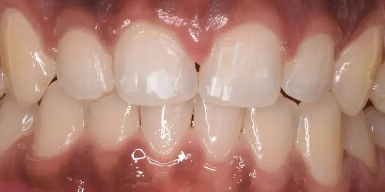 After Invisalign with large front tooth gap
