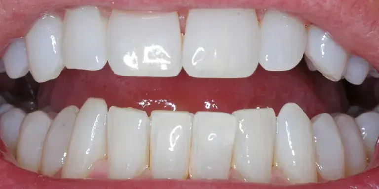 After of Dental Bonding procedure with misshapen bottom row tooth