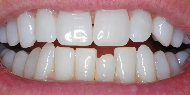 Before of Dental Bonding procedure with misshapen bottom row tooth