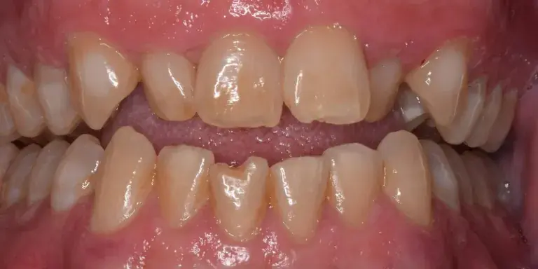 Before of full dental work with KöR whitening, Invisalign, dental bonding