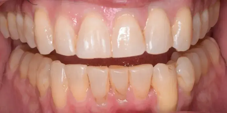 After Invisalign with visible crooked teeth on bottom row