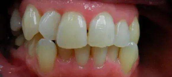 Before Invisalign with right side crooked teeth