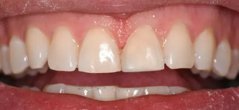 After of dental bonding with chipped front left tooth