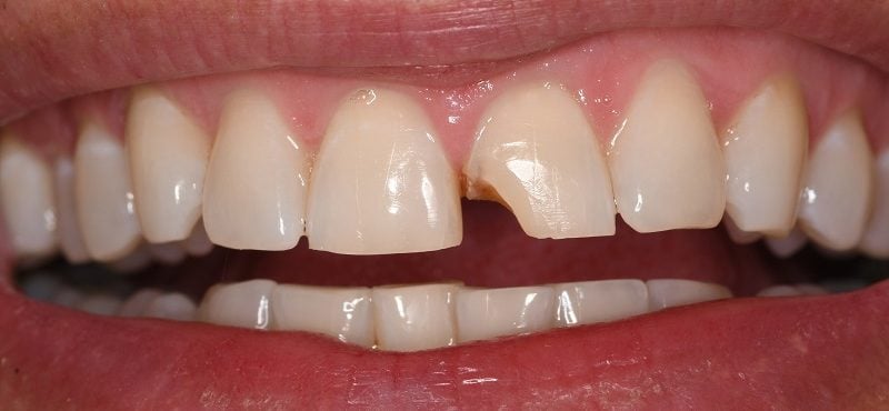 Before of dental bonding with chipped front left tooth