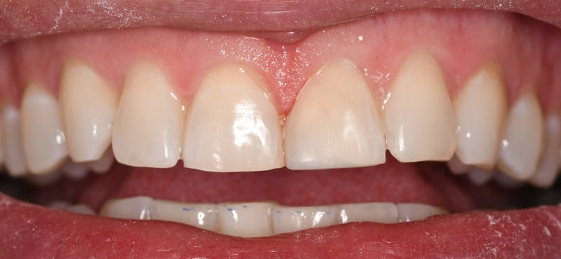 After of dental bonding with chipped front left tooth
