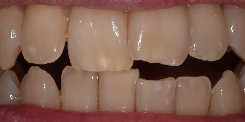 Before dental bonding procedure with misshapen front left tooth