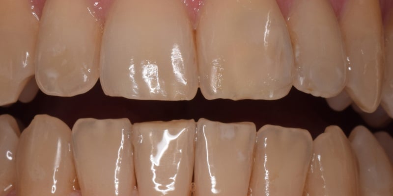 After dental bonding procedure with misshapen front left tooth