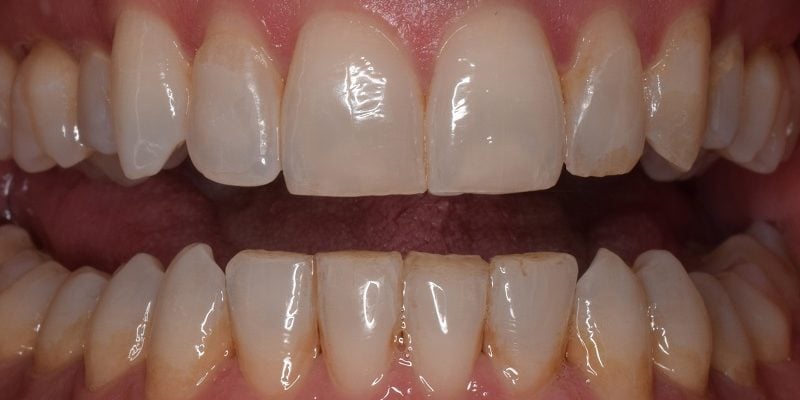 After invislign with bottom row tooth correction