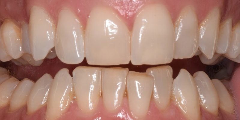 Before invislign with bottom row tooth correction