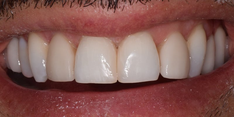 After of dental bonding with visible gap in front teeth