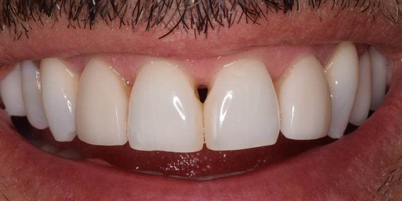 Before of dental bonding with visible gap in front teeth