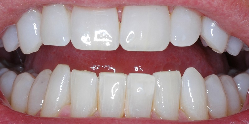 After of Dental Bonding procedure with misshapen bottom row tooth