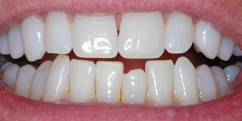 Before of Dental Bonding procedure with misshapen bottom row tooth