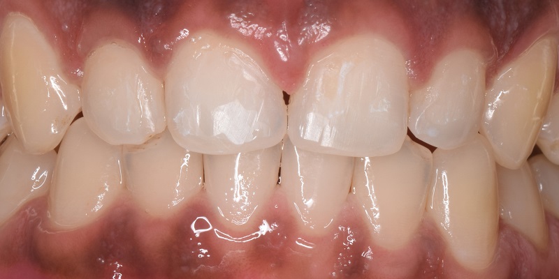 After Invisilign with large front tooth gap