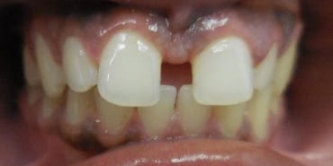 Before Invisilign with large front tooth gap