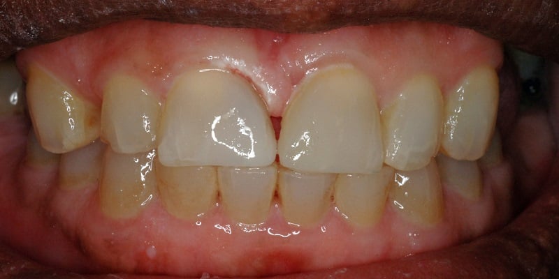 After of dental bonding with misshapen front right tooth