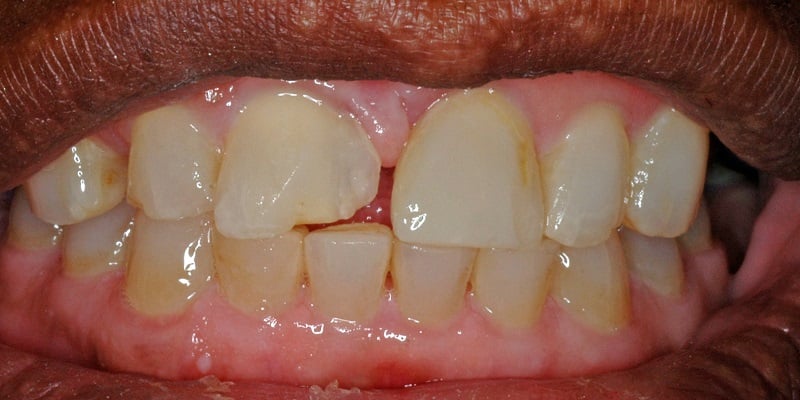 Before of dental bonding with misshapen front right tooth