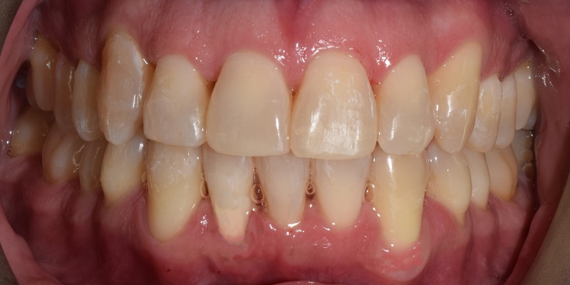 After invislign with visible crooked top and bottom row teeth
