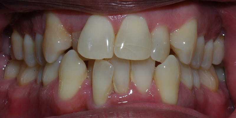 Before invislign with visible crooked top and bottom row teeth