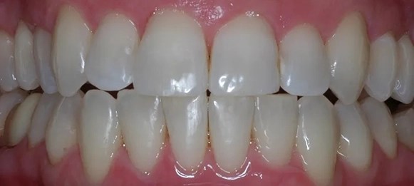 After insilign with right side crooked teeth