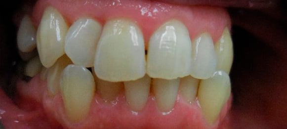 Before insilign with right side crooked teeth
