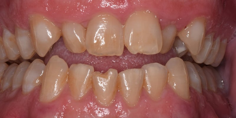 Before of full dental work with kor whitening, invislign, dental bonding