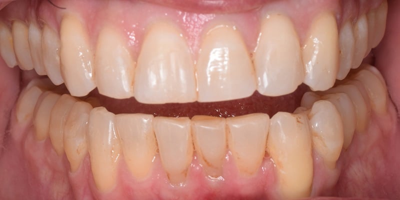 After invislign with visible crooked teeth on bottom row