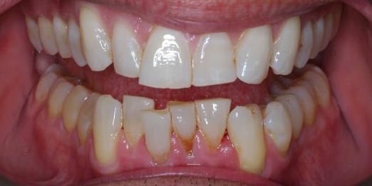 Before invislign with visible crooked teeth on bottom row