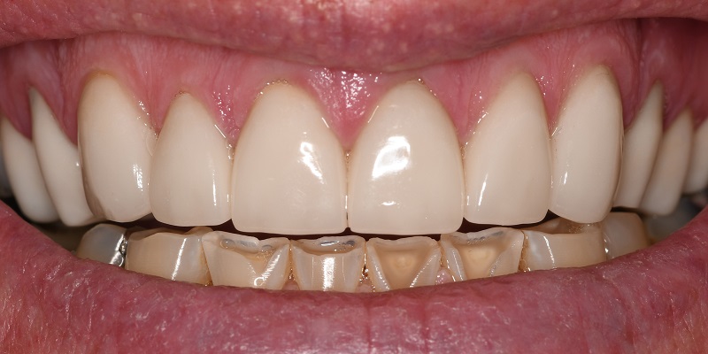 After of porcelain veneers with visible teeth staining