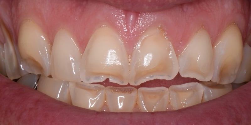 Before of porcelain veneers with visible teeth staining